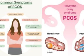 PCOS