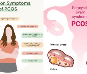 PCOS