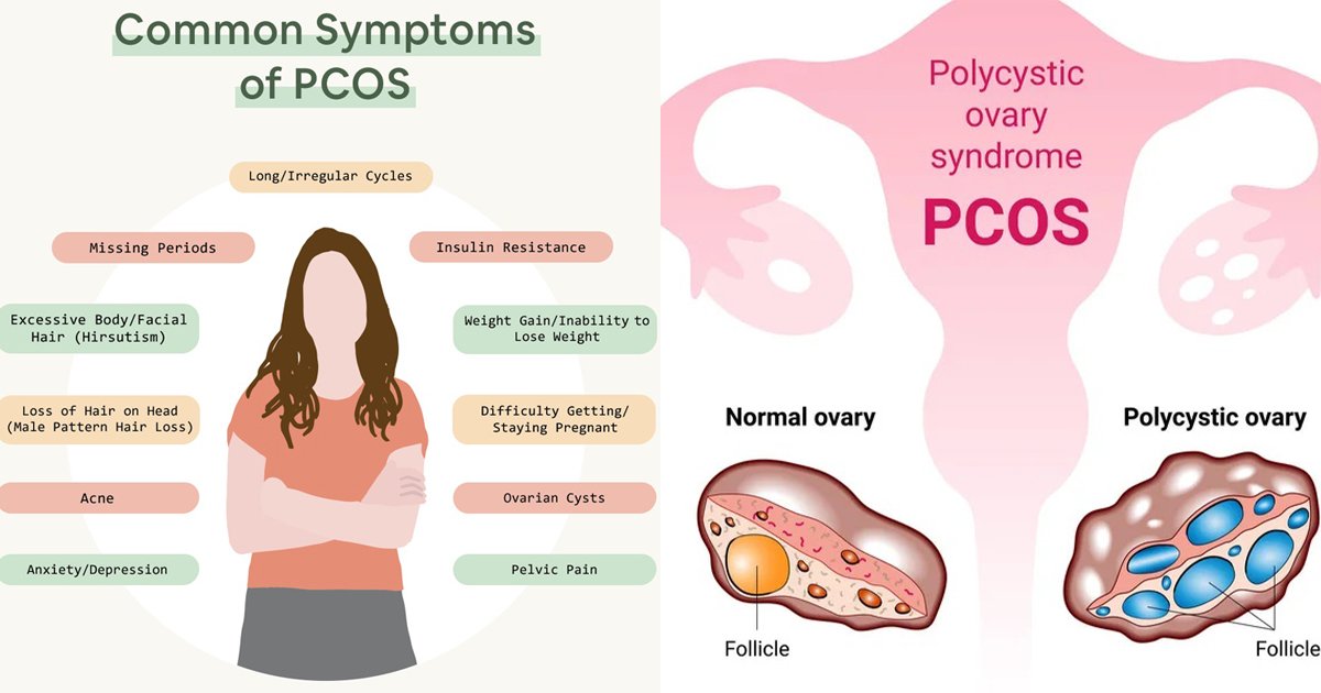 PCOS